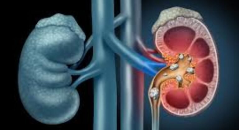 kidney stone treatment image